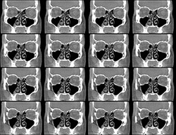 Coronal Series