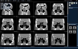 Coronal Series